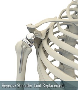 reverse-shoulder-replacement-image